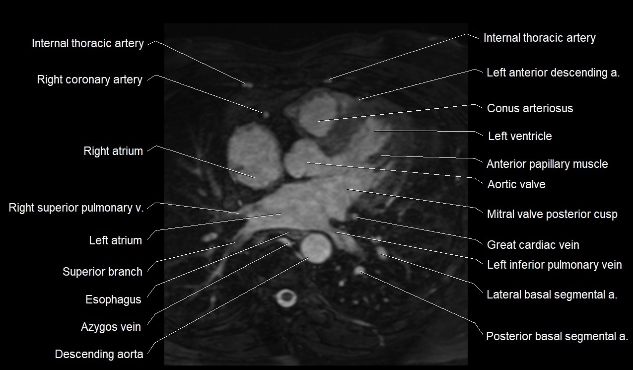 MRI heart coronary arteries and coronary veins anatomy axial image 22.webp